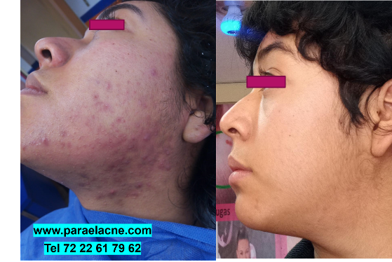 dermatologos en toluca para el acne
