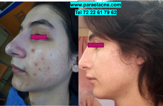 clinica para el acne toluca