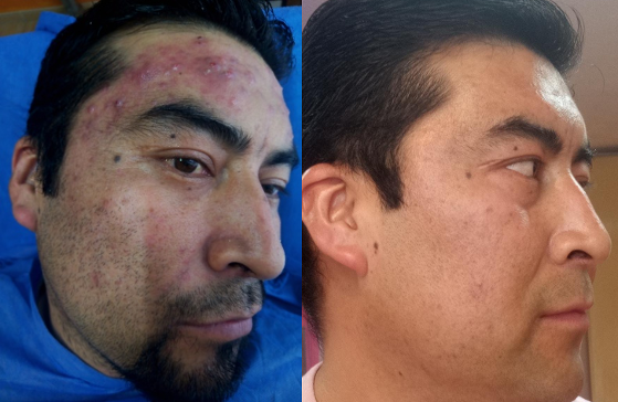 PARA EL ACNE clinica toluca