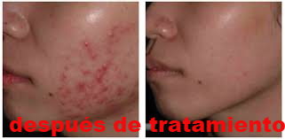 acné, tratamiento del acné, dermatólogos en toluca