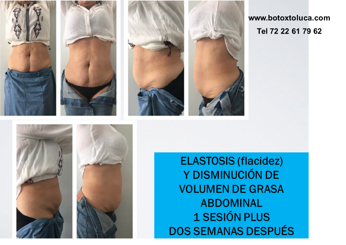 flaccidez, celulitis, mesoterapia, reducción de grasa localizada, como quitar la lonja, dermatólogos en toluca